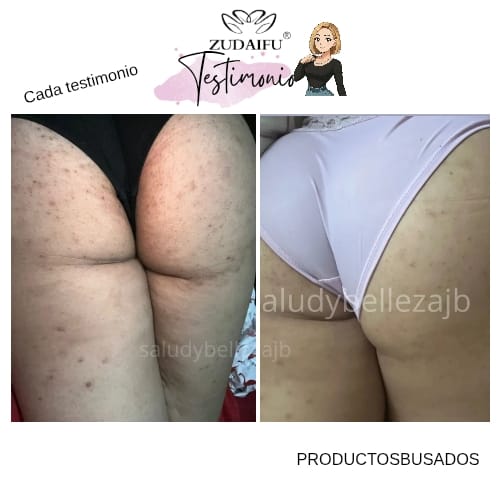Kit Antimanchas y Antifoliculitis/Antiacné