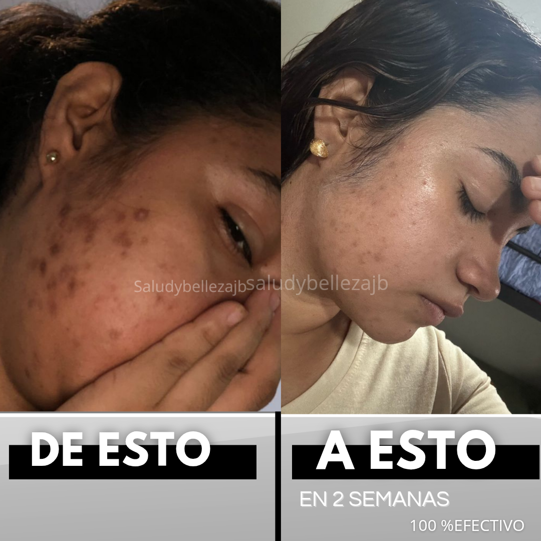 ACLARANTE DE MANCHAS OSCURAS ALTA EFECTIViDAD 🔝POCAS UNIDADES